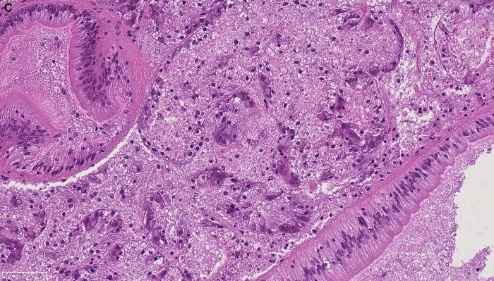Figure 1. C) Severely necrotized DG with distorted tissue architecture, 40X.